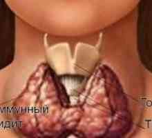 Simptomi i liječenje autoimuni tiroiditis