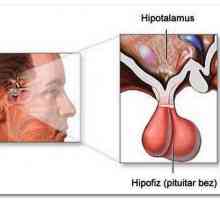 Hiperprolaktinemija sindrom: opasno kod ICD-10, izbor lijekova za liječenje