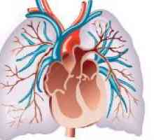 Sindroma plućne hipertenzije