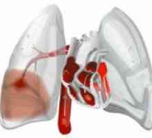 Plućne embolije (PE)