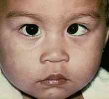 Sindrom lijeni oka (ambliopija) u odraslih i djece
