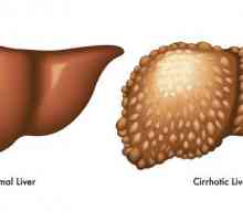 Koliko godina ljudi žive s ciroza jetre? strašna dijagnoza