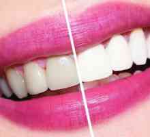 Koliko izbjeljivanje zubi u stomatologiji?