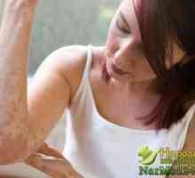Savjeti za liječenje atopijskog dermatitisa kod kuće