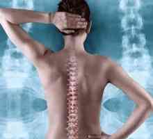 Spinal moždani udar: uzroci, simptomi, liječenje, rehabilitacija, prognoza