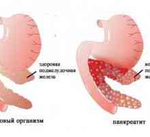 Najbolja tableta za liječenje pankreatitisa