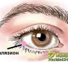 Metode liječenja oka chalazion narodnih lijekova