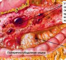 Postupci obrade nekroze pankreasa gušterače