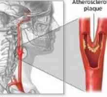 Stenoza karotidnih arterija