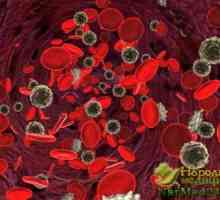 Stupanj anemije uslijed nedostatka željeza i kako liječiti ovu bolest narodnih lijekova