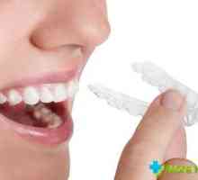 Troškovi kape uskladiti zube: Opis, vrste i kategorije cijena