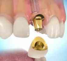 Trošak dentalnih implantata, te njihovi stavovi i gledišta