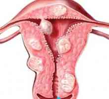 Trebam li imati pobačaj za mioma maternice?