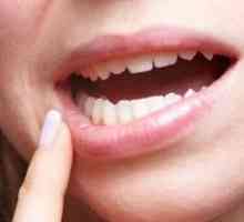 Kako liječiti stomatitis u ustima kod odraslih? Dokazane tehnike i metode