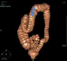 Jesu li rezultati točni daje virtualni kolonoskopija crijeva?