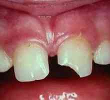 Zubni traume