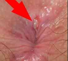 Pukotine u anus su suze rektalna sluznica. Njihova dubina mogu biti različiti.