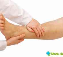 Tromboflebitisa noge: Koji su znakovi bolesti