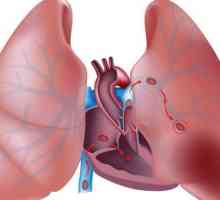 Embolija i tromboza plućne arterije