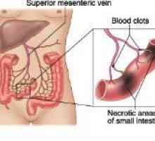 Tromboza mezenteričkih žila crijeva
