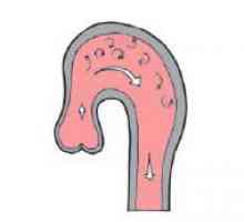 Pečat aorte (armatura letci, korijen luka): simptomi, uzroci, kako se izliječiti