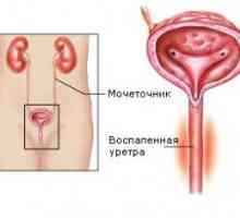Uretritis kod žena, folk tretman. Simptomi bolesti.