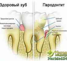 Uspješno liječenje parodontitisa narodnih lijekova kod kuće