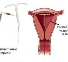 Instalacija IUD nakon poroda