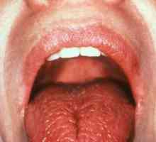 Što je uzrok trnci jezik?