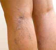 Proširene vene u nogama: više je to opasno?