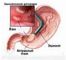Vrste, simptomi i liječenje gastritisa catarrhal
