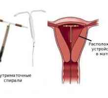 Intrauterini ulošci za kontracepciju: što je bolje?