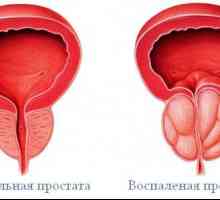 Upale prostate (prostatitis)