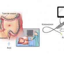 Da li crijeva screening kolonoskopija ili možda za vrijeme menstruacije?