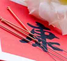 Sve o akupunktura: posebno primjena u neuralgije