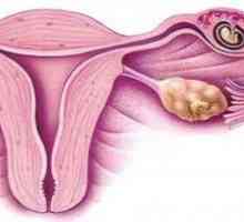 Identifikacija ranim fazama izvanmaternične trudnoće: simptomi i dijagnoze.
