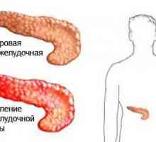 Osnove prevencije pankreatitisa