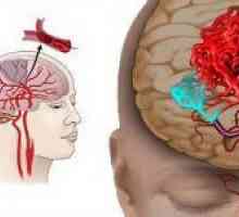 Bolest mozga vaskularnoj porijekla