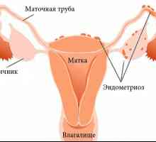 Zašto se dodjeljuje na fizikalnu terapiju endometrioze