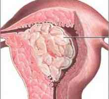 Žljezdane hiperplazije endometrija: uzroci, oblici i stupnjevi obrade