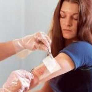Apsces kože - simptomi i tretman