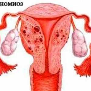 Adenomioza i endometrioza: kako razlikovati između tih bolesti?