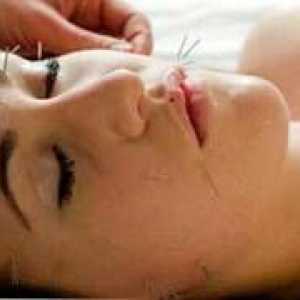 Akupunktura - novi način Lifting lica bez intervencije kirurga