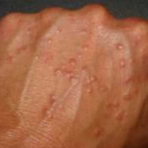 Alergijski vaskulitis