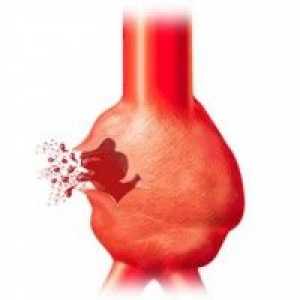 Aneurizma abdominalne aorte: simptomi, dijagnoza, liječenje