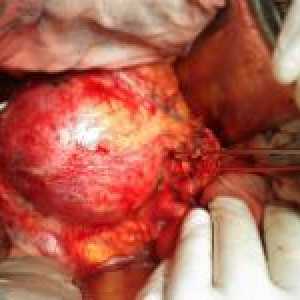 Aneurizme aorte, njegove vrste i liječenje