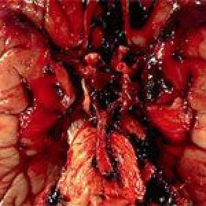 Aneurizme mozga (mozak) i njeno liječenje