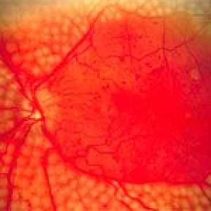 Mrežnice angiopatija oči i njeno liječenje