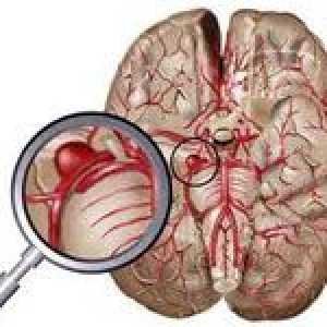 Glavni simptomi moždanog aneurizma