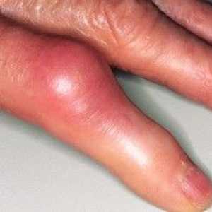 Artritis zglobova prstiju